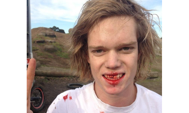 Sam King has smiles with a bloody mouth.